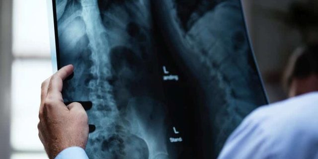 Un sfert dintre pacienţii care şi-au făcut bronhoscopii la Spitalul Județean Arad au fost diagnosticaţi cu neoplasm pulmonar / Simptome: dureri în piept, respiraţie greoaie, tuse prelungită, infecţii pulmonare dese
