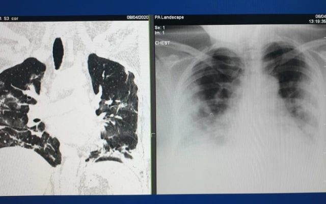 Răcelile suspectate de pneumonie - Cazuri de pneumonie misterioasă, semnalate și în Hong Kong