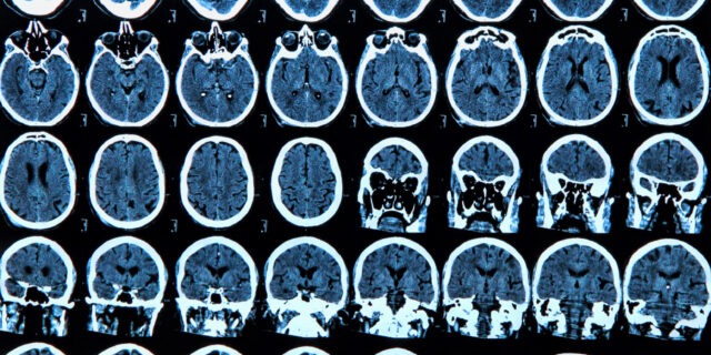 creier, radiografie, activitate cerebrala, parkinson, afectiune neurologica, CT, computer tomograf, raze X, neuroni
