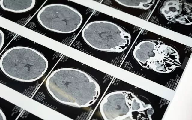 creier, radiografie, activitate cerebrala, parkinson, afectiune neurologica, CT, computer tomograf, raze X, neuroni